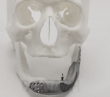 بازسازی صدمات صورت با تکنولوژی 3D