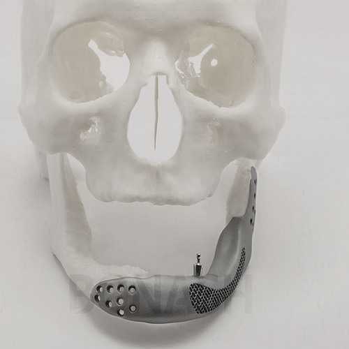 بازسازی صدمات صورت با تکنولوژی 3D